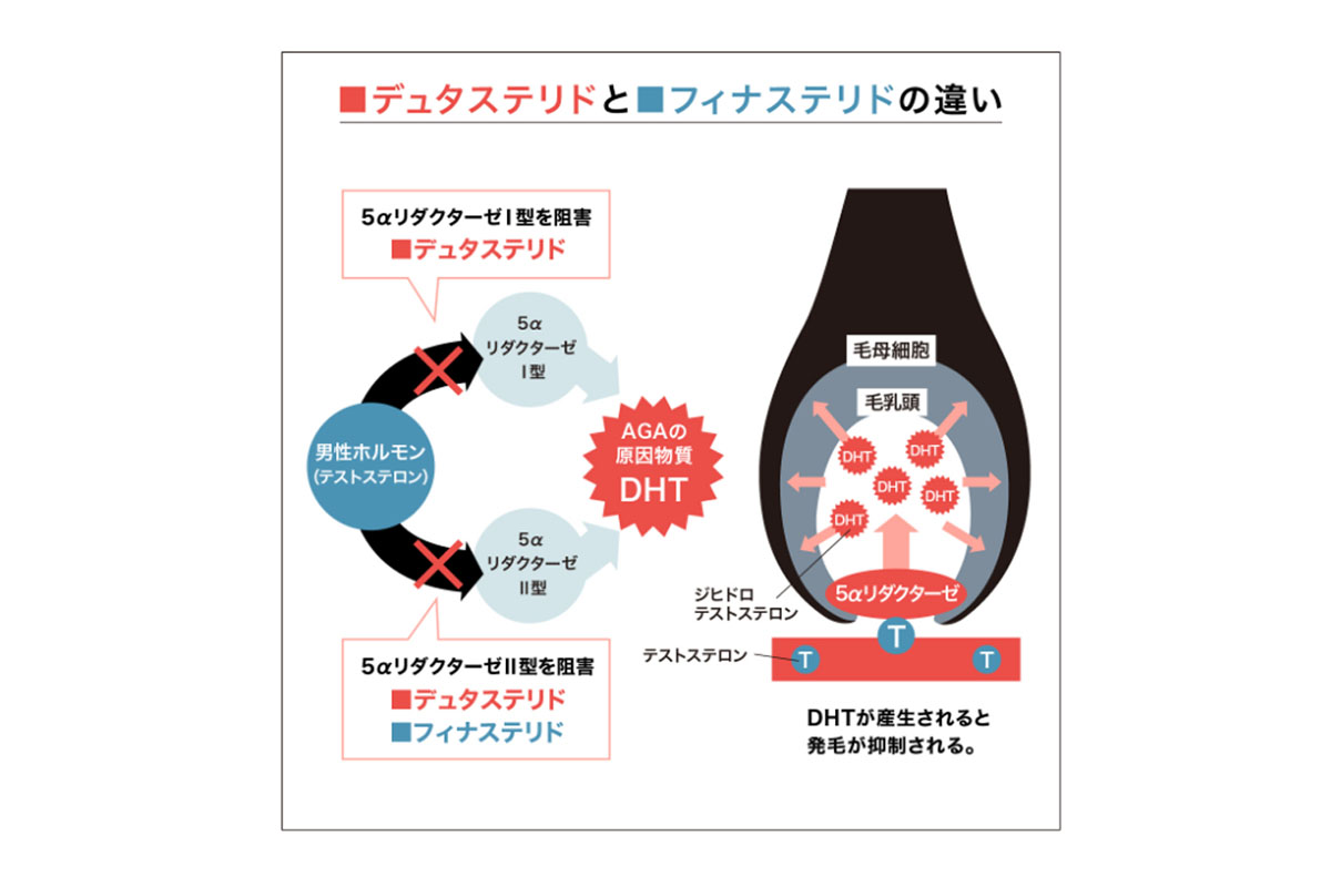フィナステリドとデュタステリドの違い