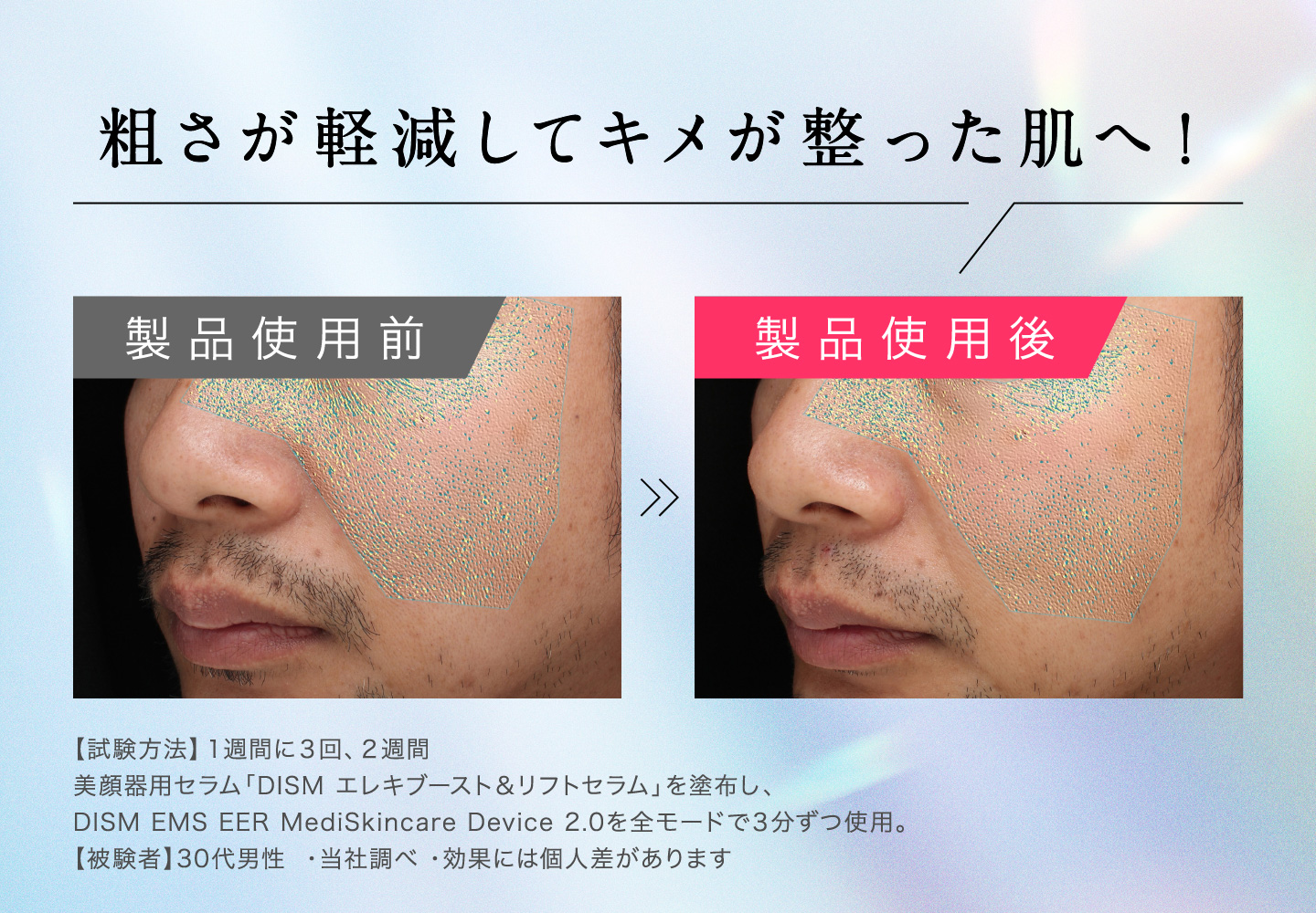 粗さが軽減してキメが整った肌へ！ 製品使用前 ≫ 製品使用後 【試験方法】1週間に3回、2週間 美顔器用セラム「DISM エレキブースト＆リフトセラム」を塗布し、DISM EMS EER MediSkincare Device 2.0を全モードで3分ずつ使用。 【被験者】30代男性 ・当社調べ ・効果には個人差があります