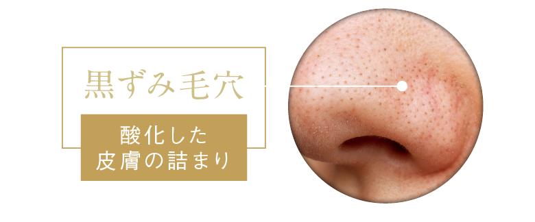 黒ずみ毛穴 酸化した皮膚の詰まり