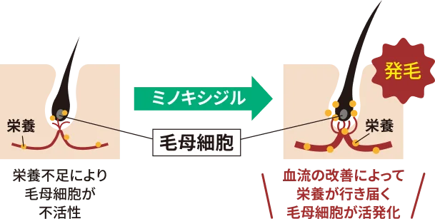 栄養不足により毛母細胞が不活性 ミノキシジルで 血流の改善によって栄養が行き届く毛母細胞が活性化