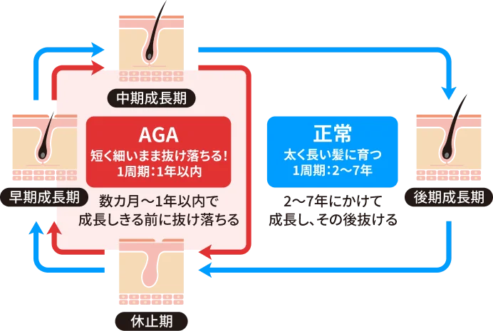 【正常】太く長い髪に育つ 1周期：2〜7年 2〜7年にかけて成長し、その後抜ける 【AGA】短く細いまま抜け落ちる！ 1周期：1年以内 数カ月〜1年以内で成長しきる前に抜け落ちる