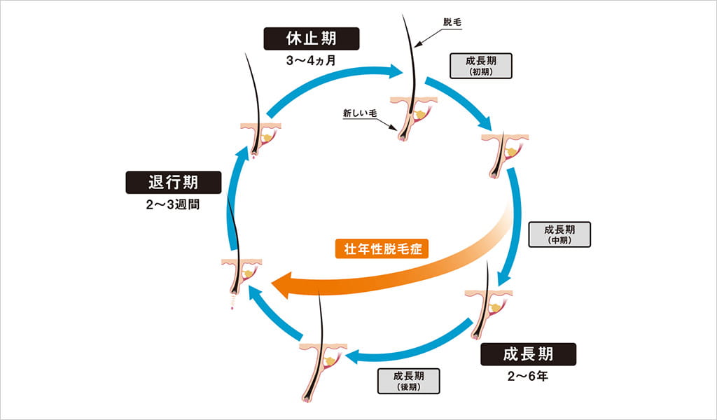 壮年性脱毛症のメカニズム