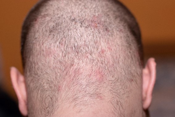 【毛髪診断士監修】男の頭皮の臭いの原因は？シャンプー選びなどの対策方法を徹底解説