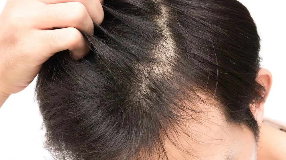 毛根から血が出る理由　髪を抜くと薄毛（ハゲ）に影響するのか？