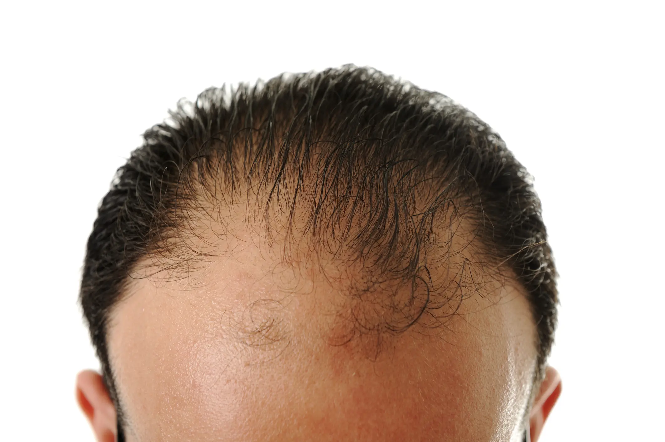 ホホバオイルで頭皮ケア！適度な保湿で乾燥や抜け毛、薄毛などを改善しよう