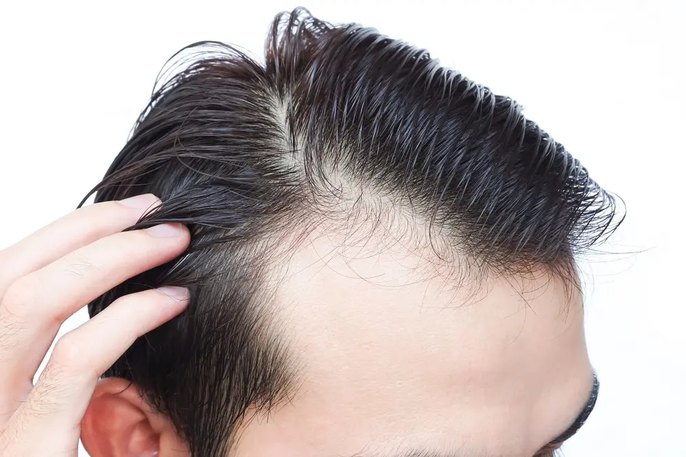 【毛髪診断士監修】気になるつむじ割れ…将来薄毛（ハゲ）の原因になるかも？