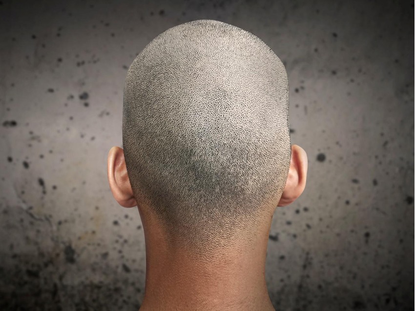 トラブル別髪の毛のケア方法 - 頭皮トラブルの種類
