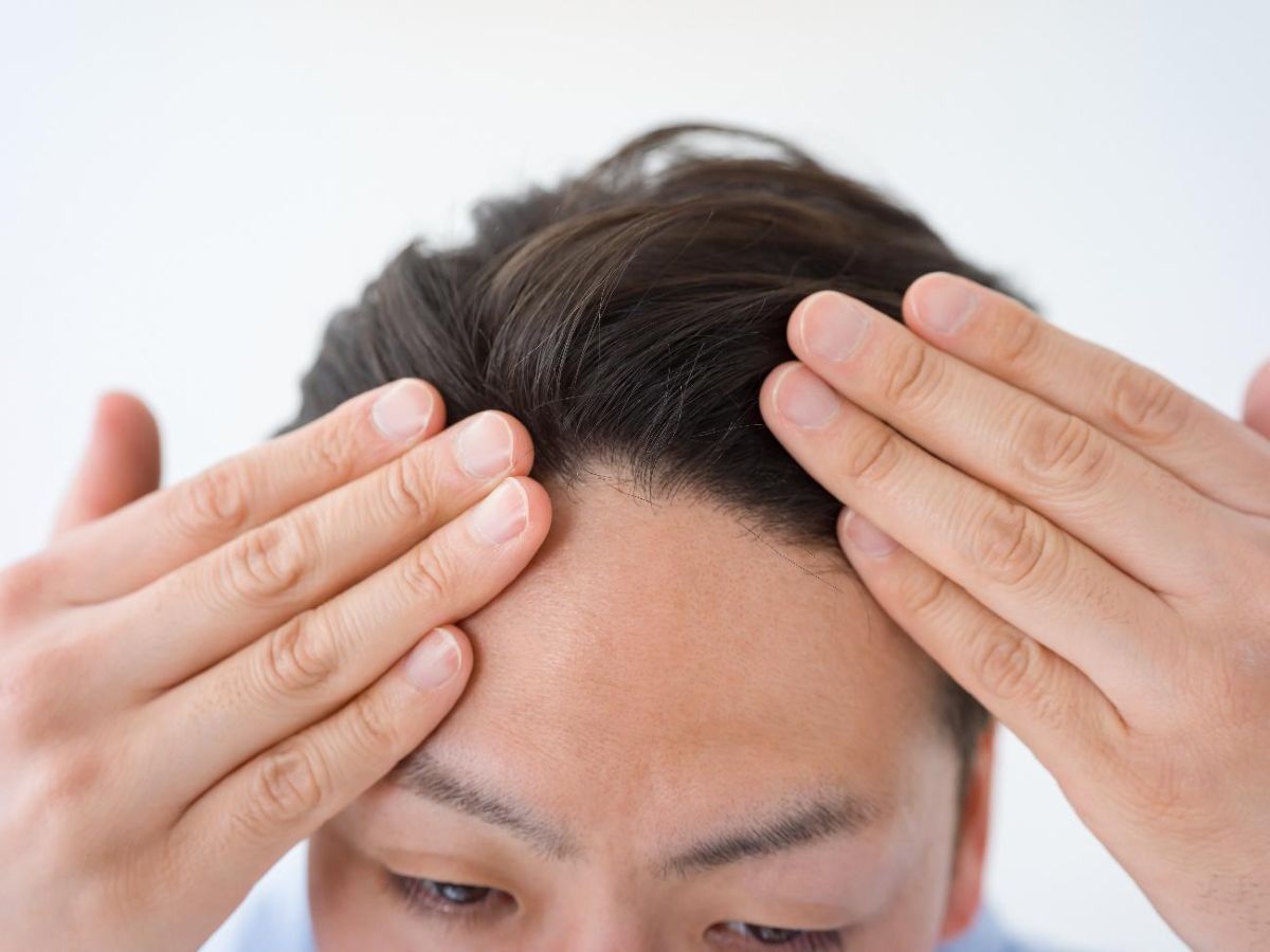 前頭部が薄毛になる5つの原因
