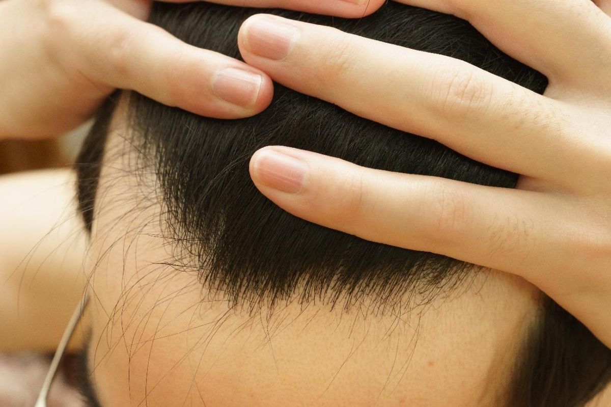 生え際が後退しているサイン