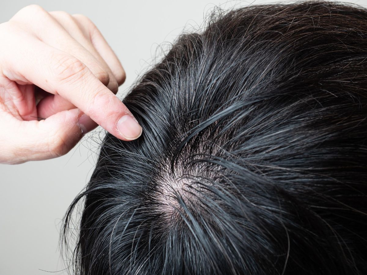 つむじはげの進行度合い